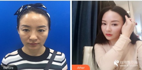 重慶愛德華醫院有限公司整形美(měi)容中心戴彥泓住院醫(yī)師(shī)整形價格表附埋線提升案例展示